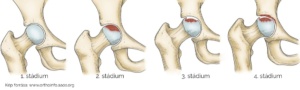 Csípőízületi artrózis stádiumai. Kép forrása: www.orthoinfo.aaos.org