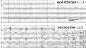 Egészséges és epilepsziás EEG