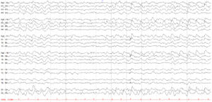 A mély alvás EEG képe