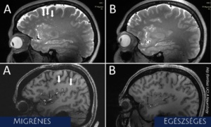 Migrénes és egészséges agy MRI képe (UCLA | Wilson Xu)